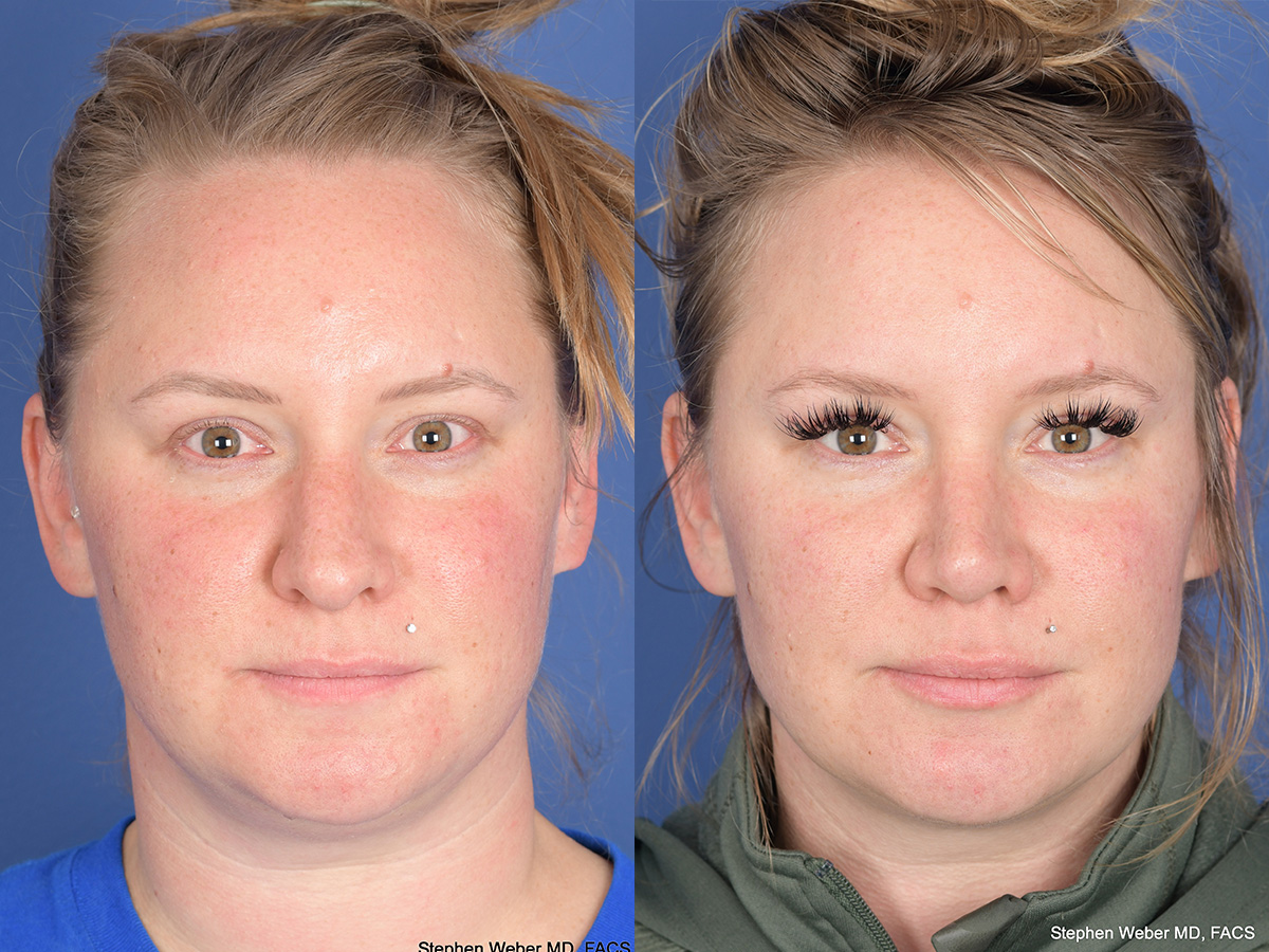 Rhinoplasty Before and After | Weber Facial Plastic Surgery