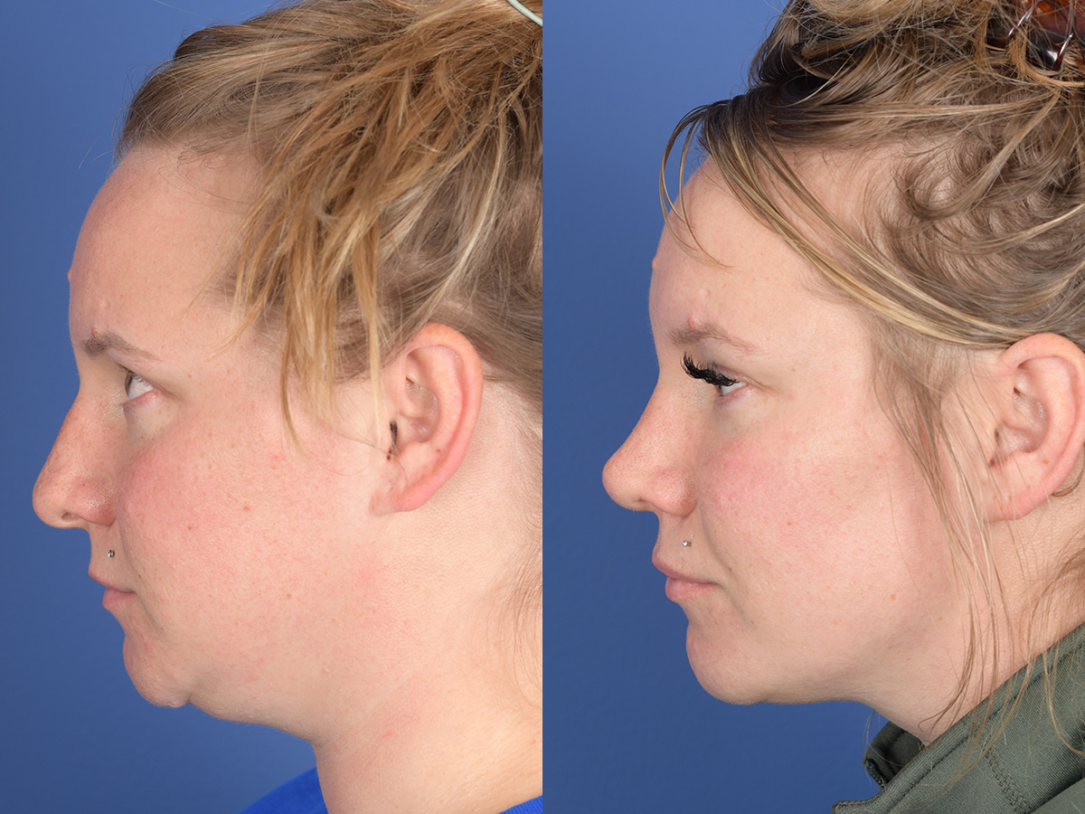 Rhinoplasty Before and After | Weber Facial Plastic Surgery
