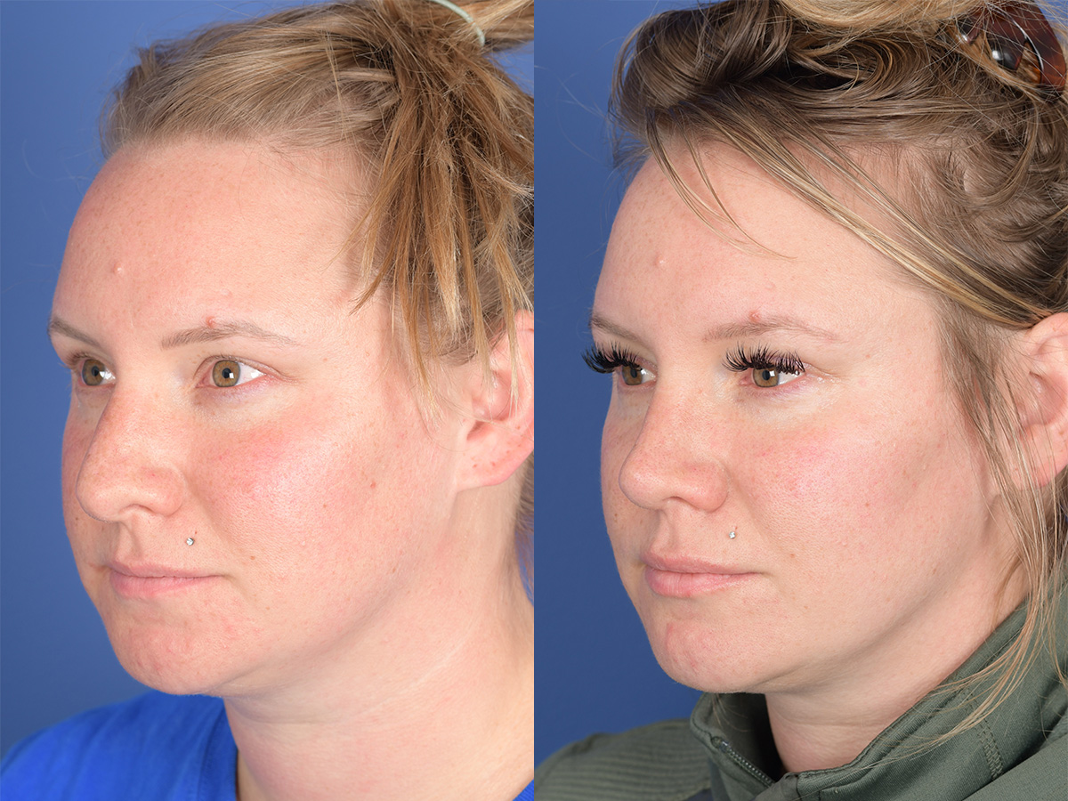 Rhinoplasty Before and After | Weber Facial Plastic Surgery
