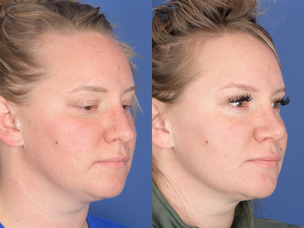 Rhinoplasty Before and After | Weber Facial Plastic Surgery