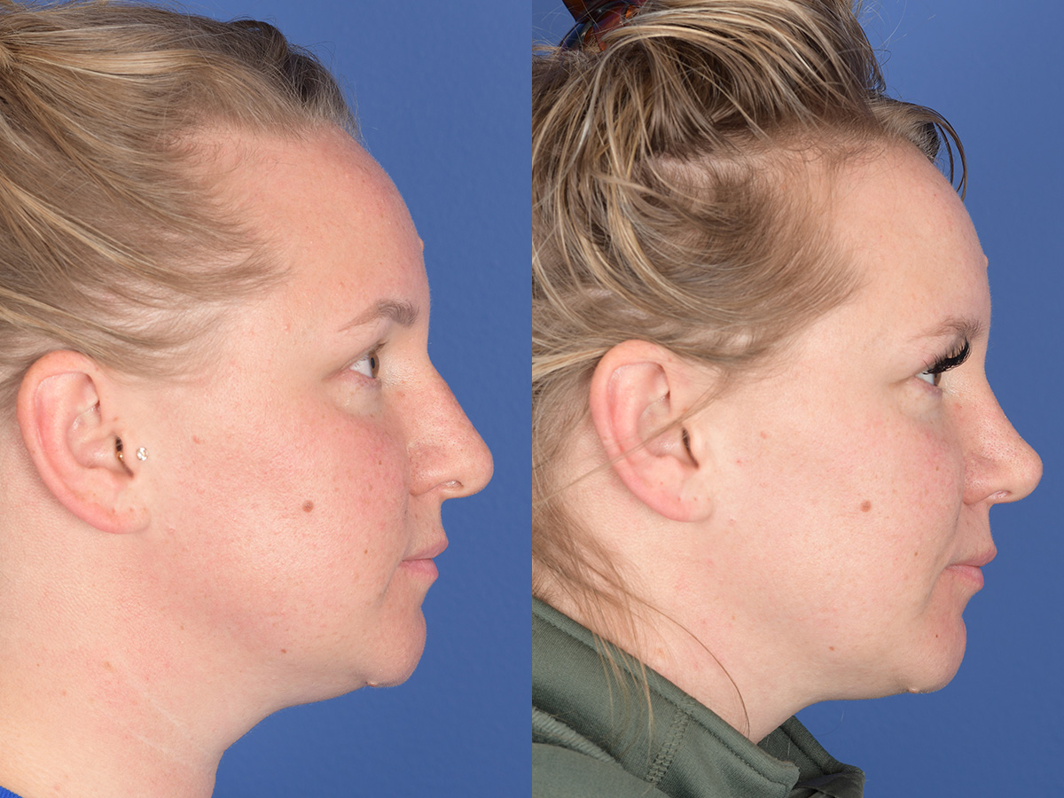 Rhinoplasty Before and After | Weber Facial Plastic Surgery