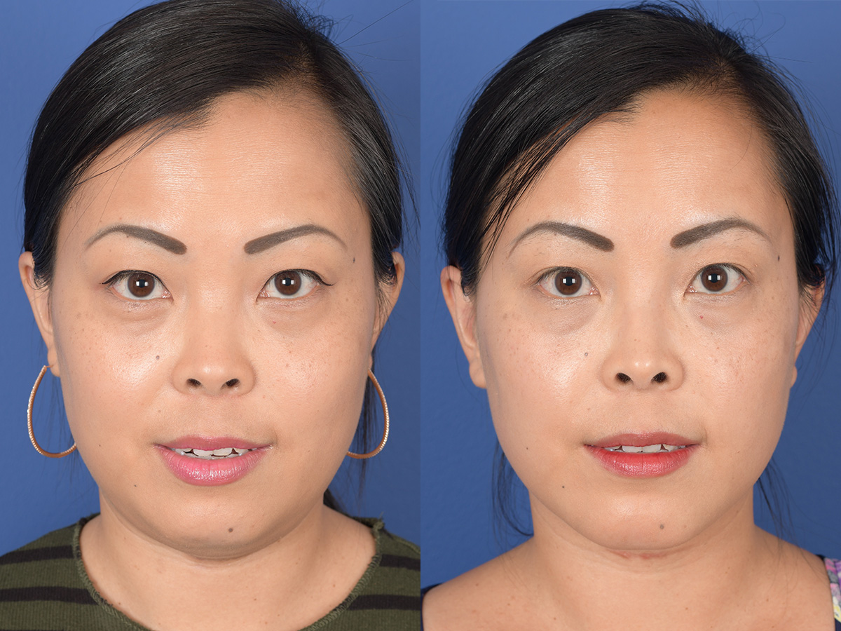 Rhinoplasty Before and After | Weber Facial Plastic Surgery