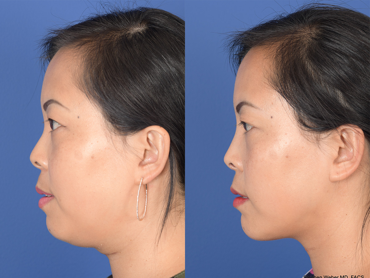 Rhinoplasty Before and After | Weber Facial Plastic Surgery