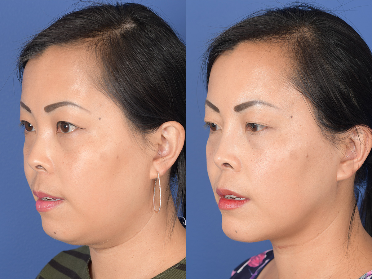 Rhinoplasty Before and After | Weber Facial Plastic Surgery