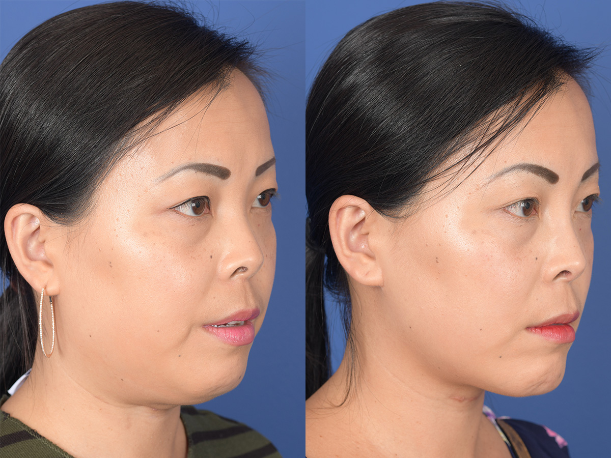 Rhinoplasty Before and After | Weber Facial Plastic Surgery