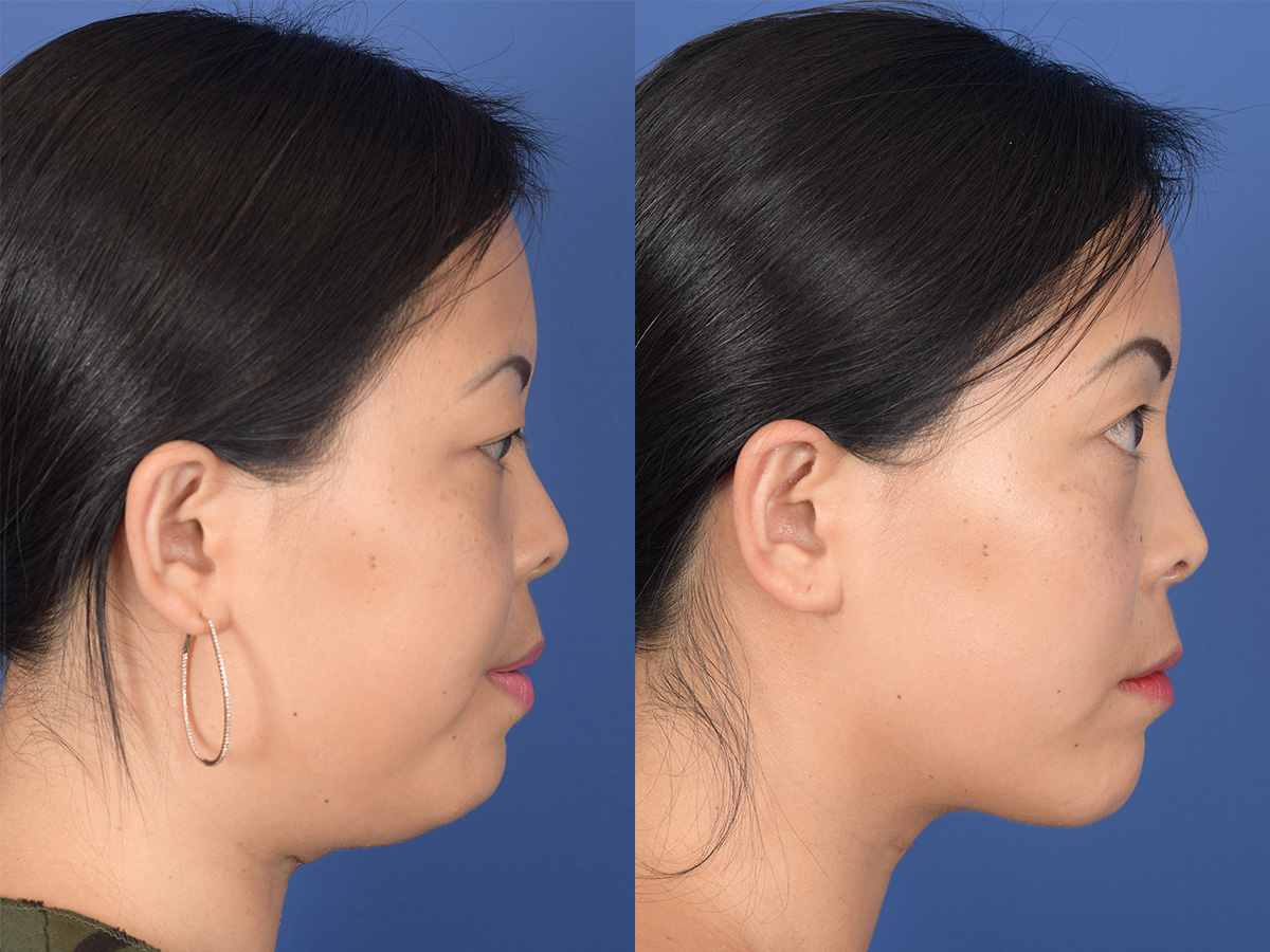 Rhinoplasty Before and After | Weber Facial Plastic Surgery