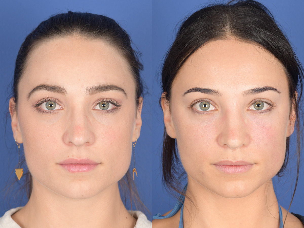 Rhinoplasty Before and After | Weber Facial Plastic Surgery