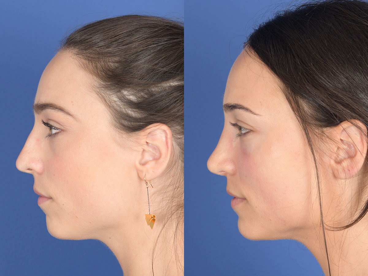 Rhinoplasty Before and After | Weber Facial Plastic Surgery
