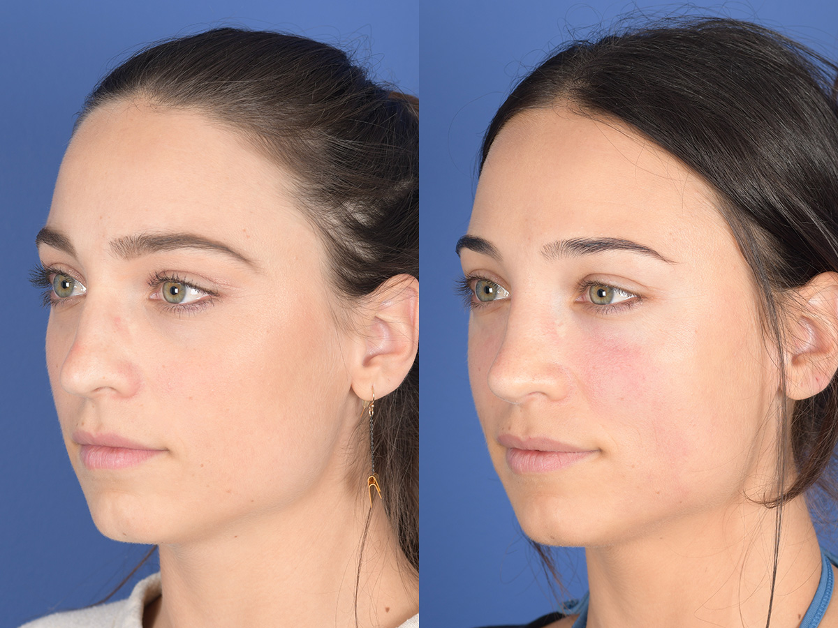 Rhinoplasty Before and After | Weber Facial Plastic Surgery