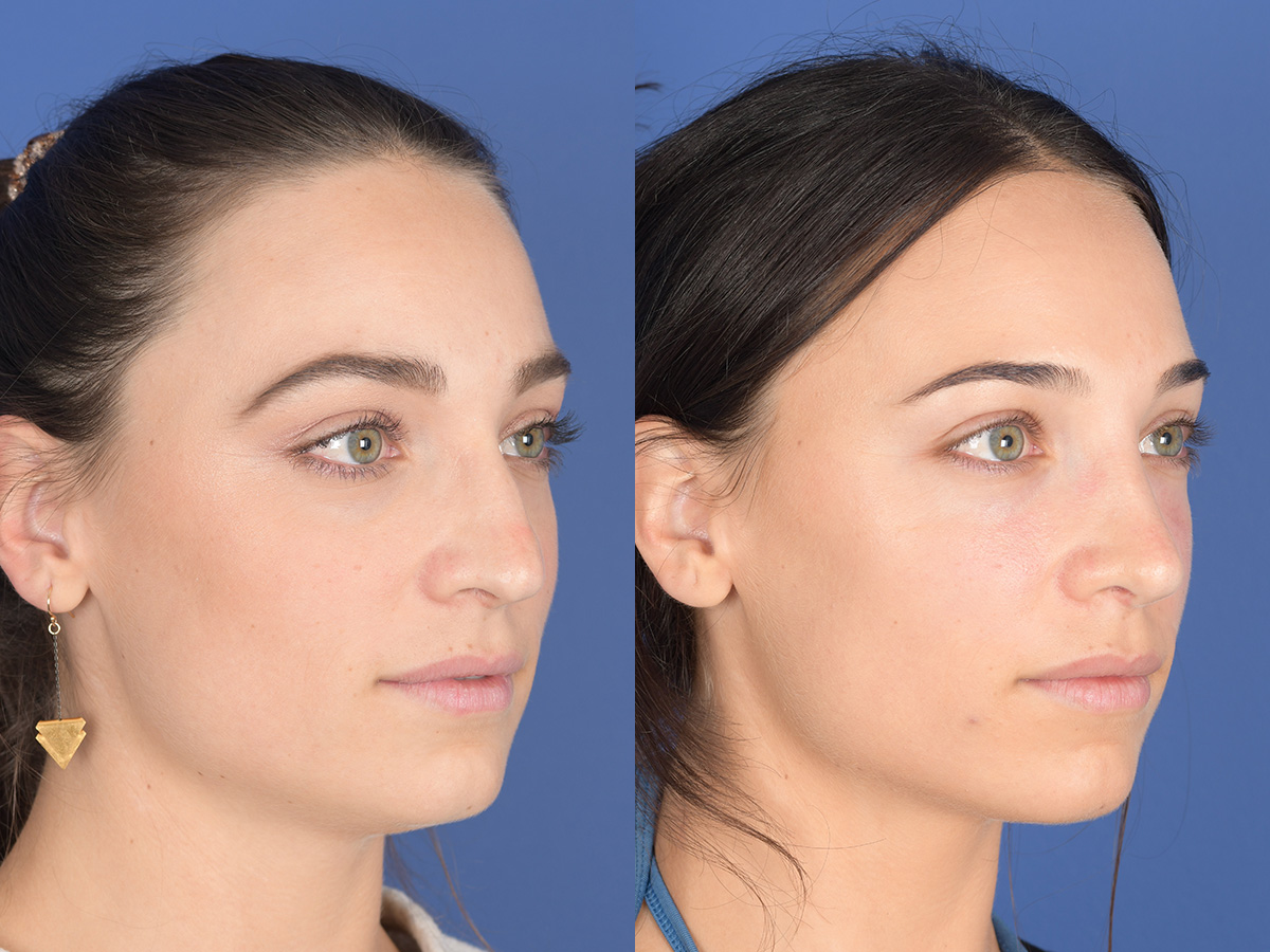 Rhinoplasty Before and After | Weber Facial Plastic Surgery