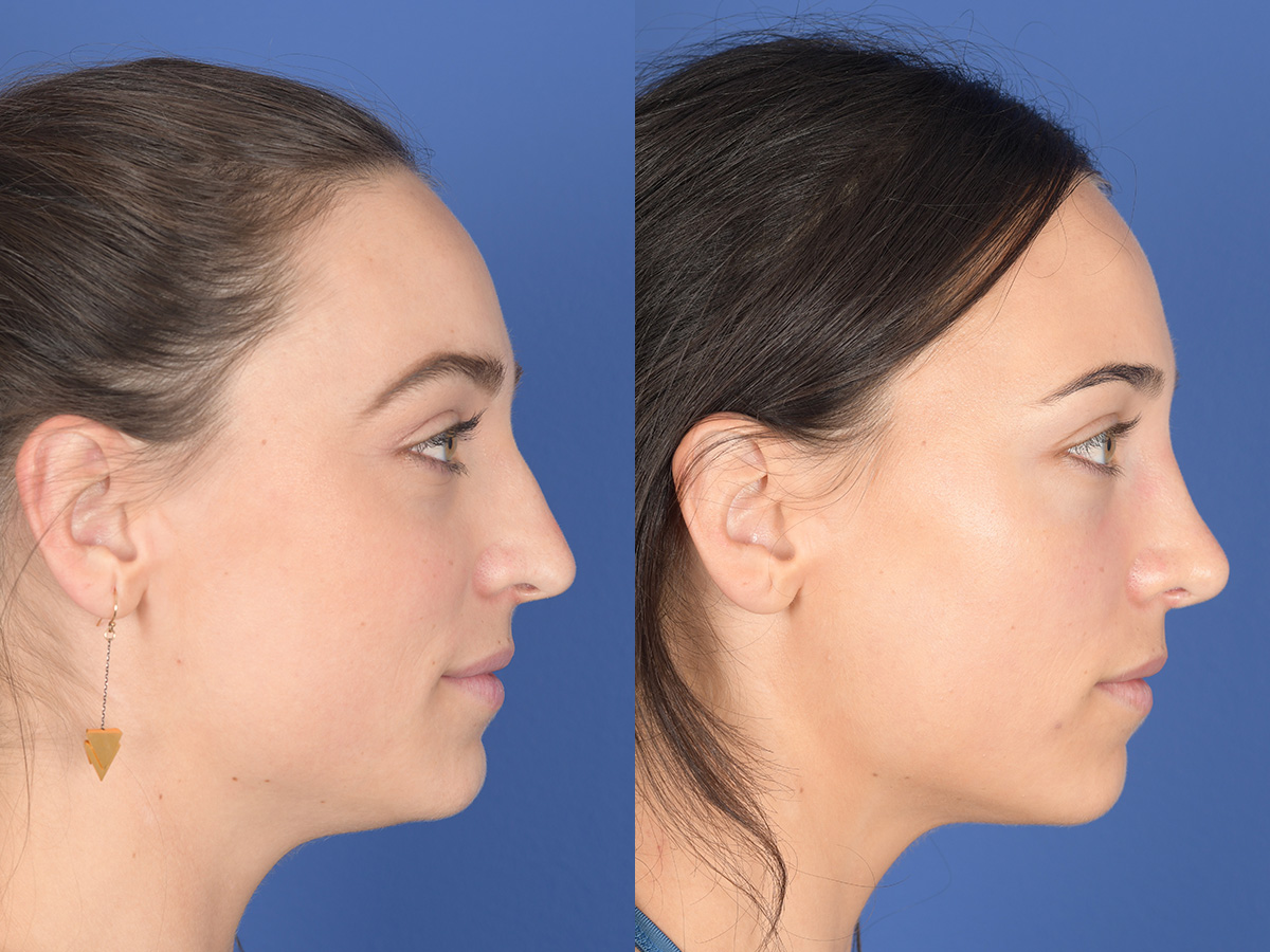 Rhinoplasty Before and After | Weber Facial Plastic Surgery