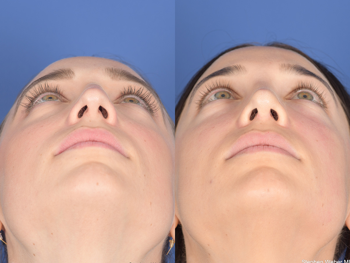 Rhinoplasty Before and After | Weber Facial Plastic Surgery