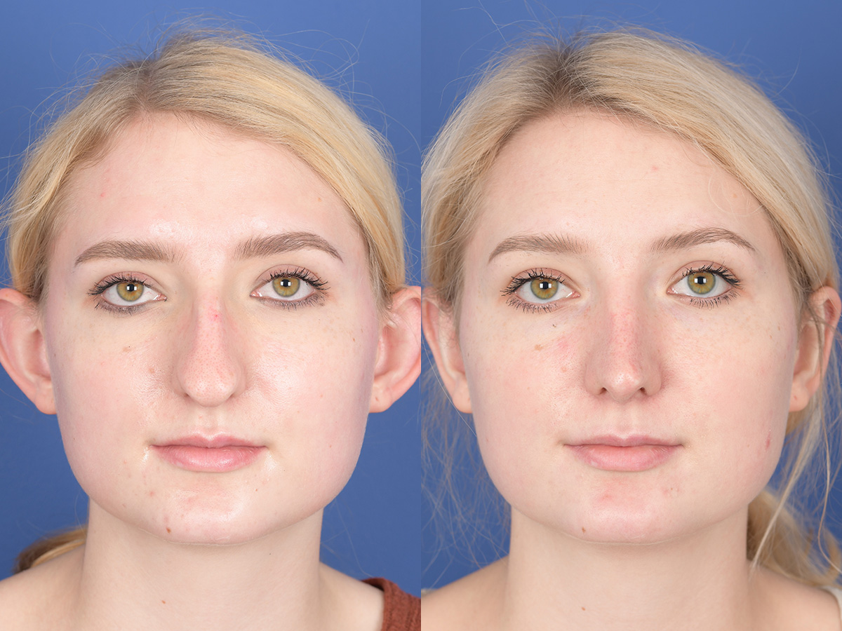 Rhinoplasty Before and After | Weber Facial Plastic Surgery