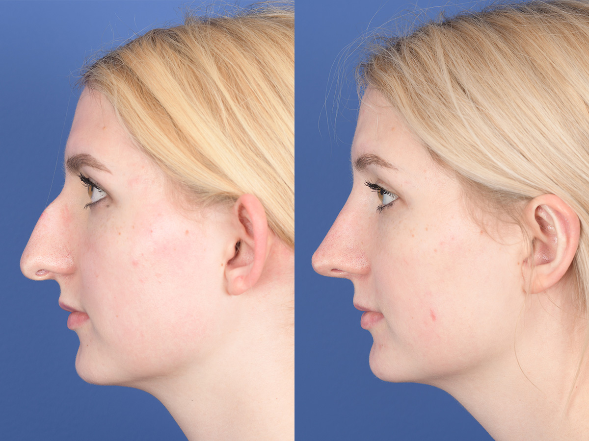 Rhinoplasty Before and After | Weber Facial Plastic Surgery