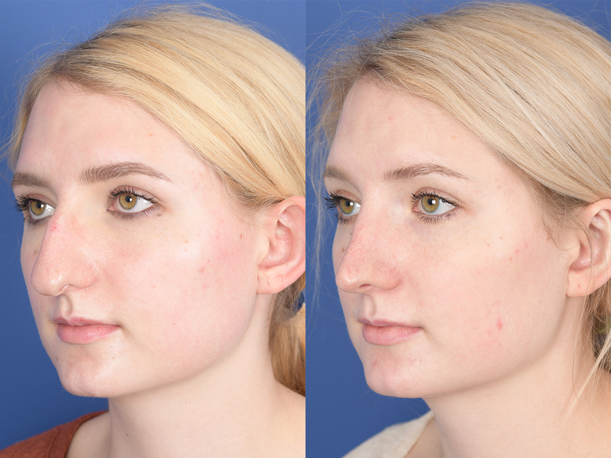 Rhinoplasty Before and After | Weber Facial Plastic Surgery