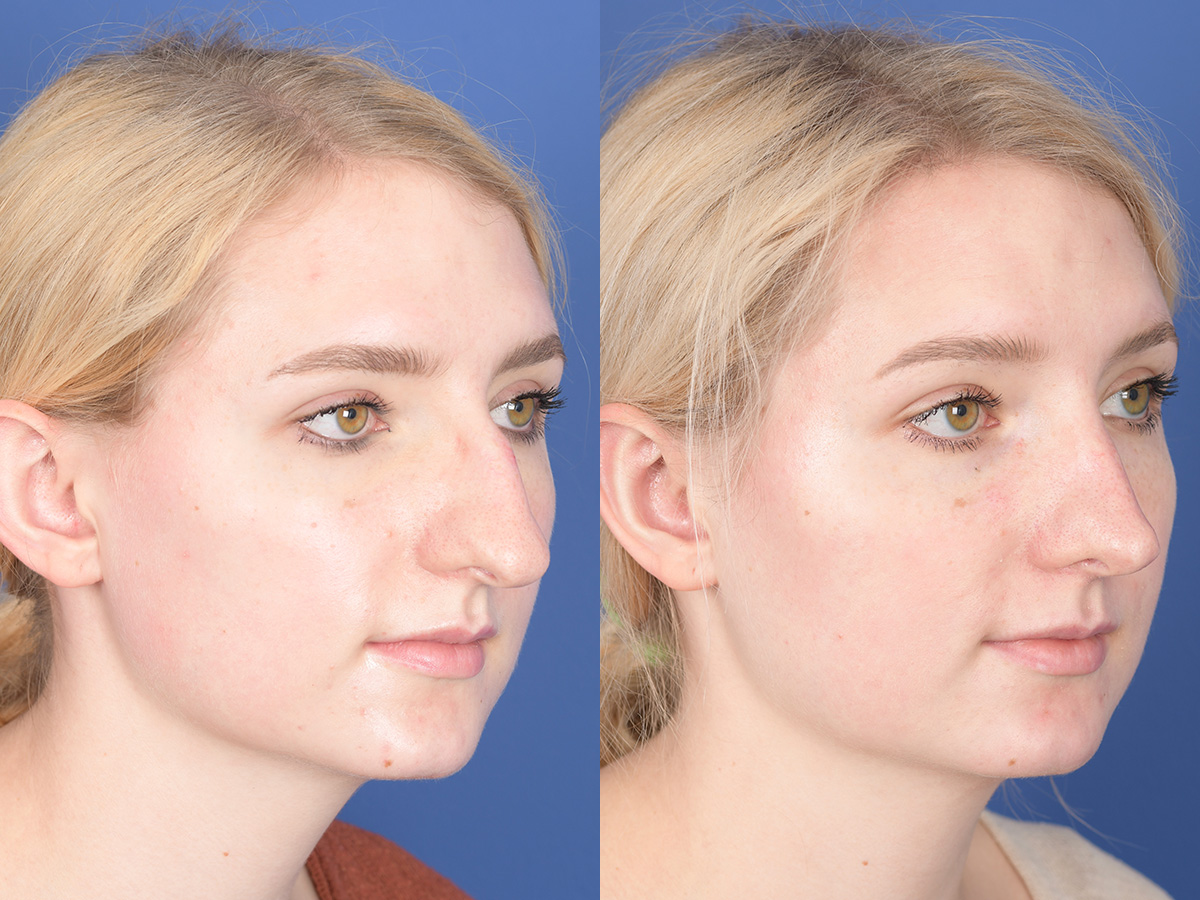 Rhinoplasty Before and After | Weber Facial Plastic Surgery