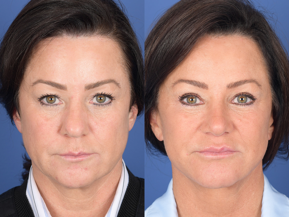 Rhinoplasty Before and After | Weber Facial Plastic Surgery