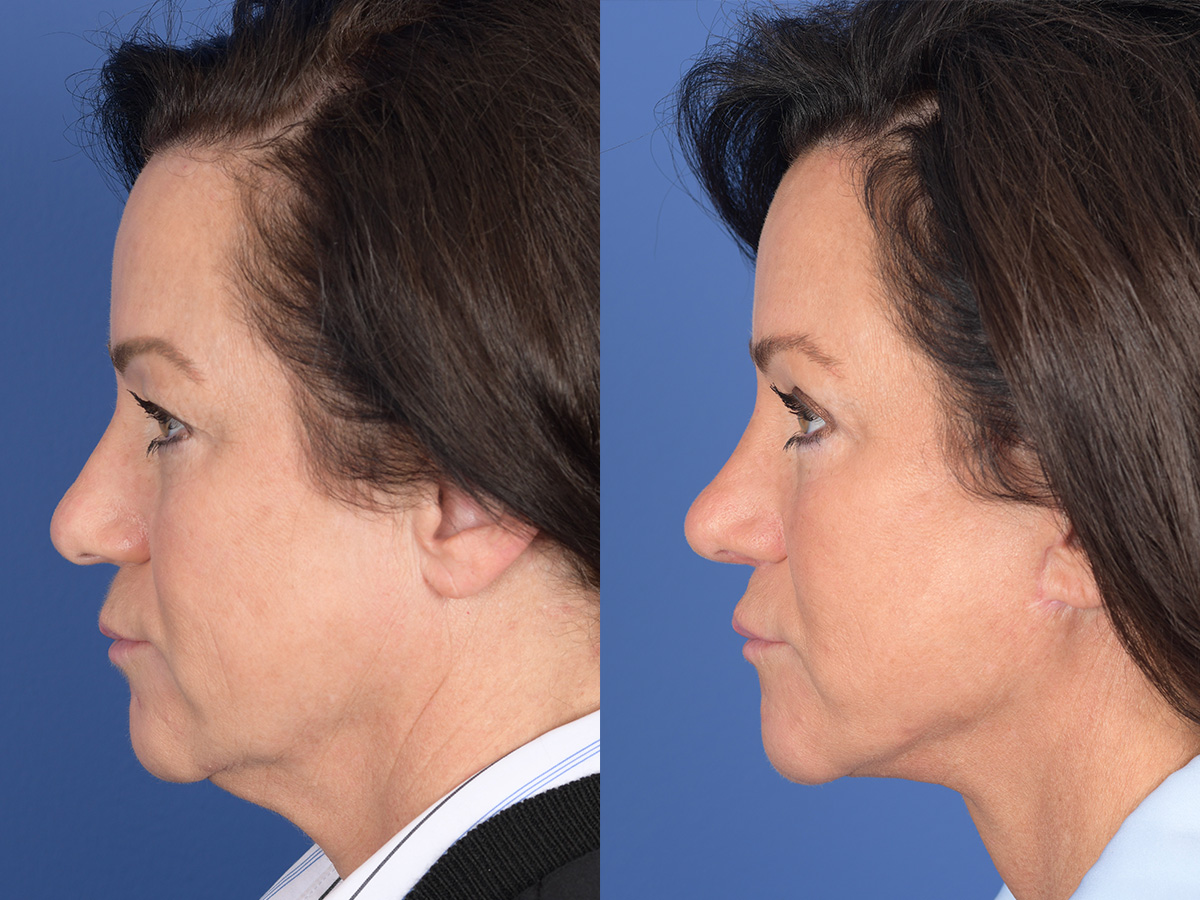 Rhinoplasty Before and After | Weber Facial Plastic Surgery
