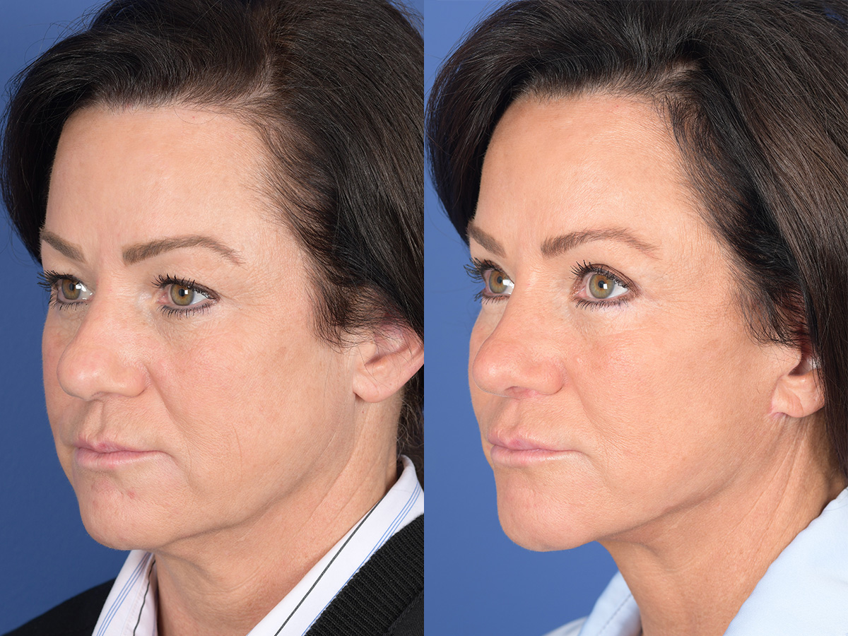 Rhinoplasty Before and After | Weber Facial Plastic Surgery