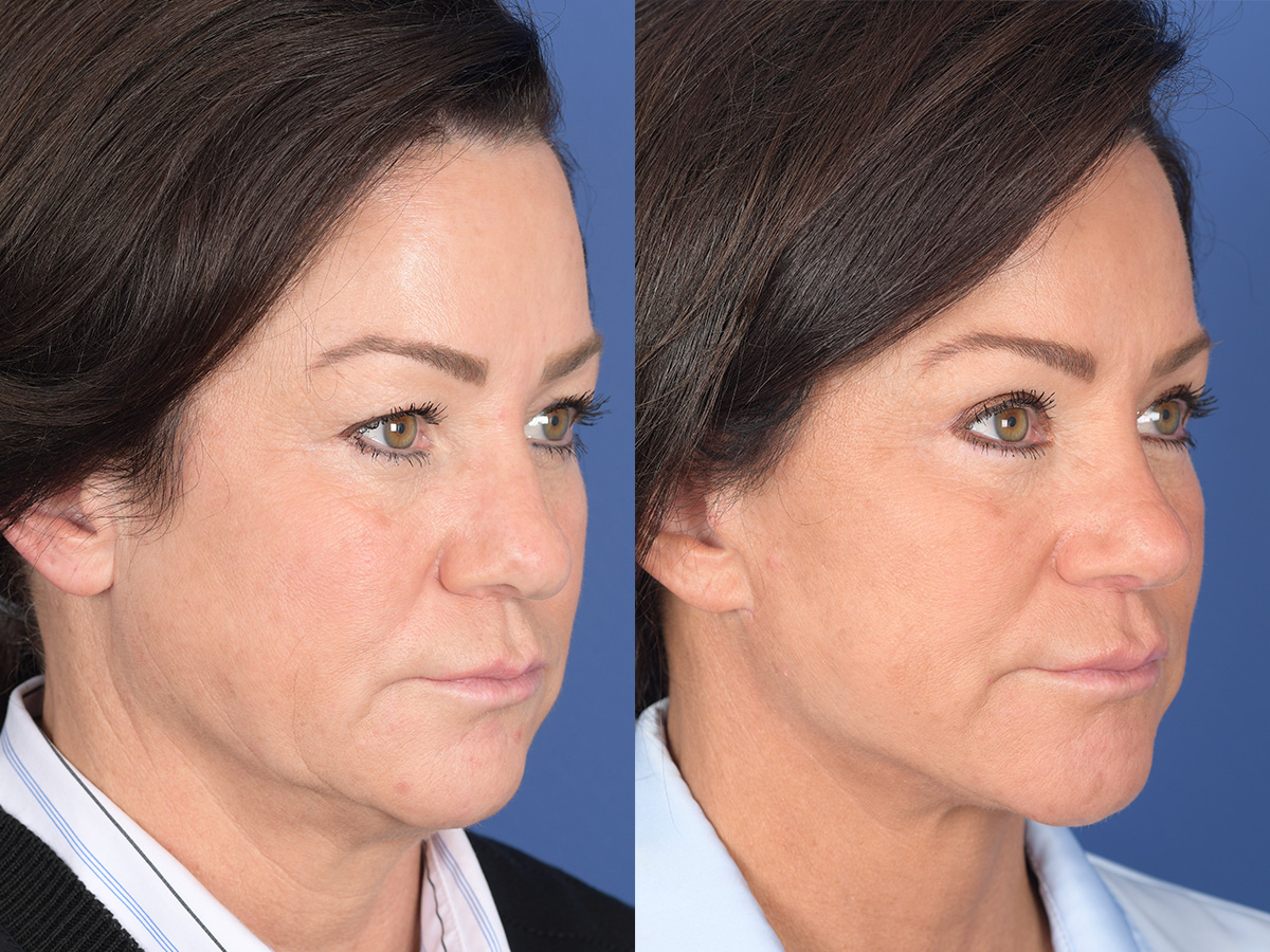 Rhinoplasty Before and After | Weber Facial Plastic Surgery