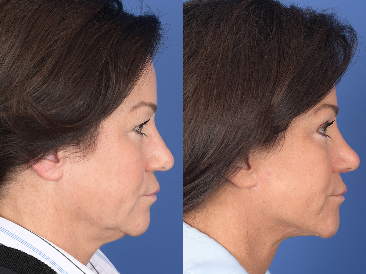 Rhinoplasty Before and After | Weber Facial Plastic Surgery