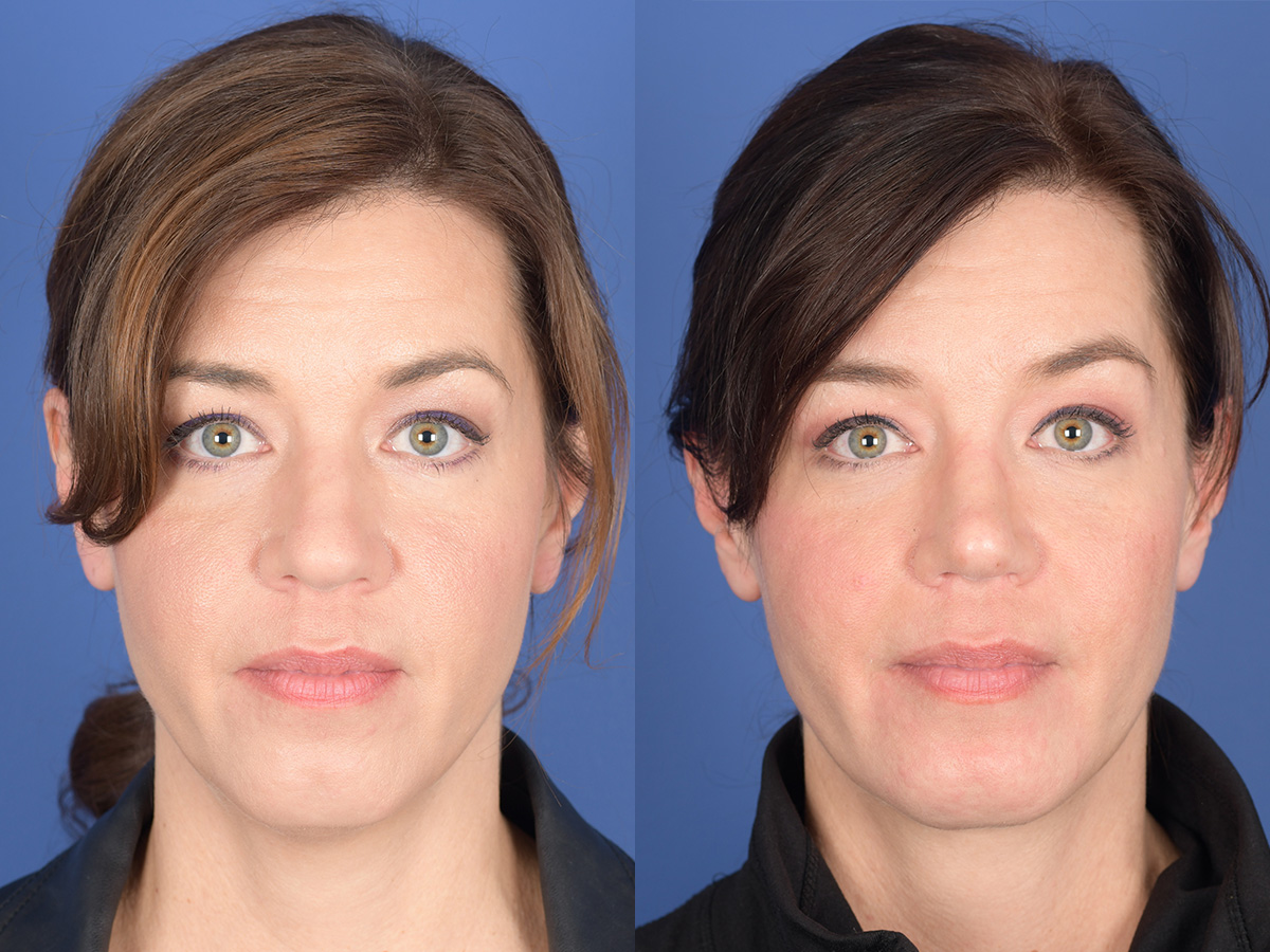 Rhinoplasty Before and After | Weber Facial Plastic Surgery