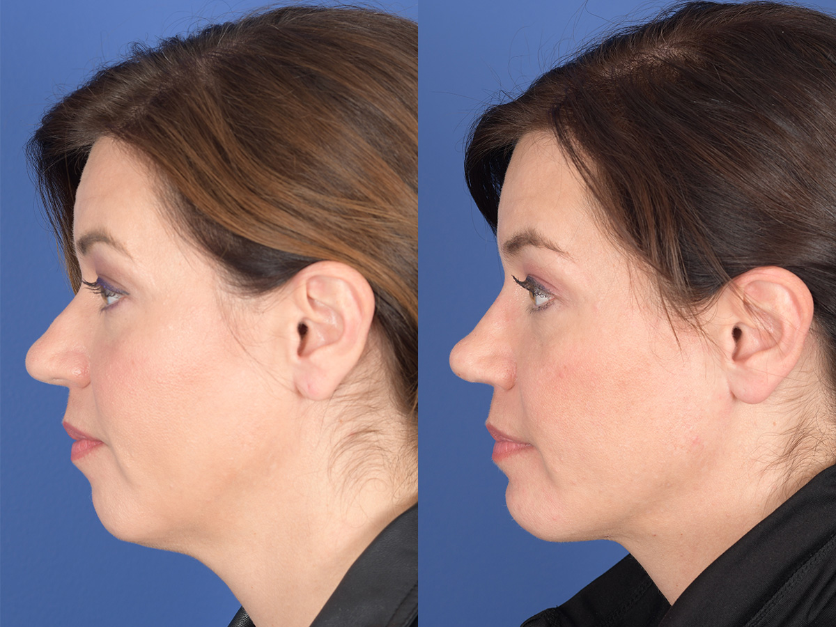 Rhinoplasty Before and After | Weber Facial Plastic Surgery