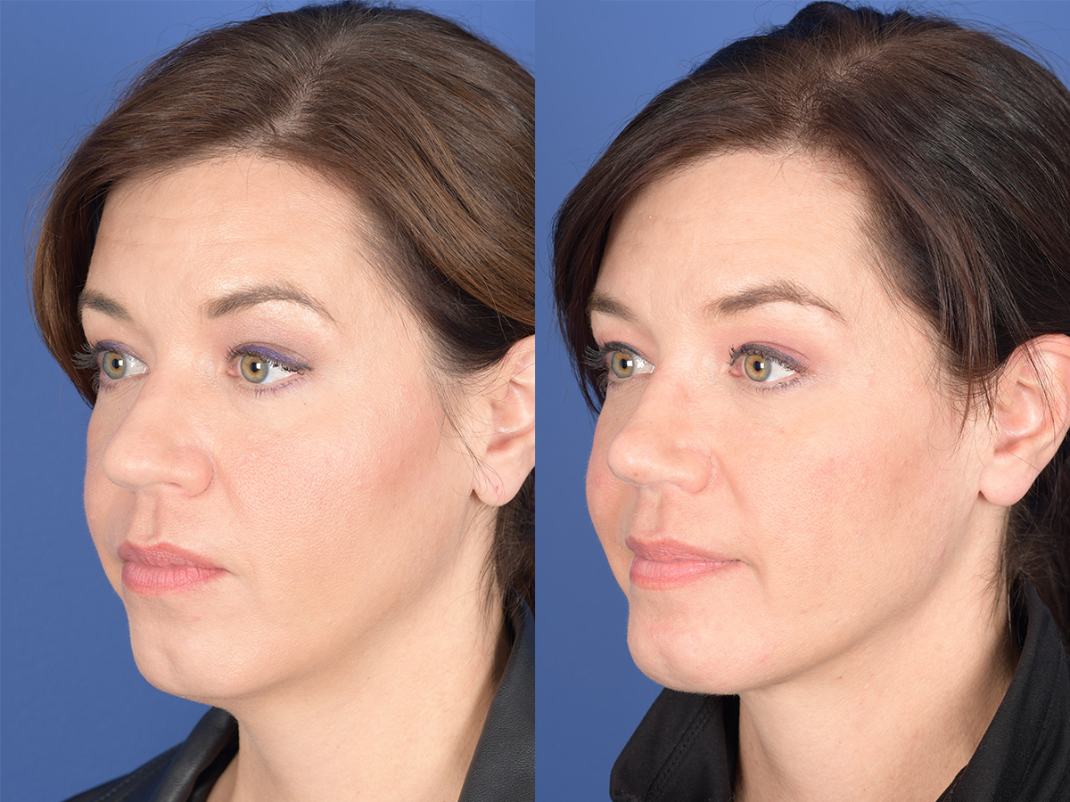 Rhinoplasty Before and After | Weber Facial Plastic Surgery