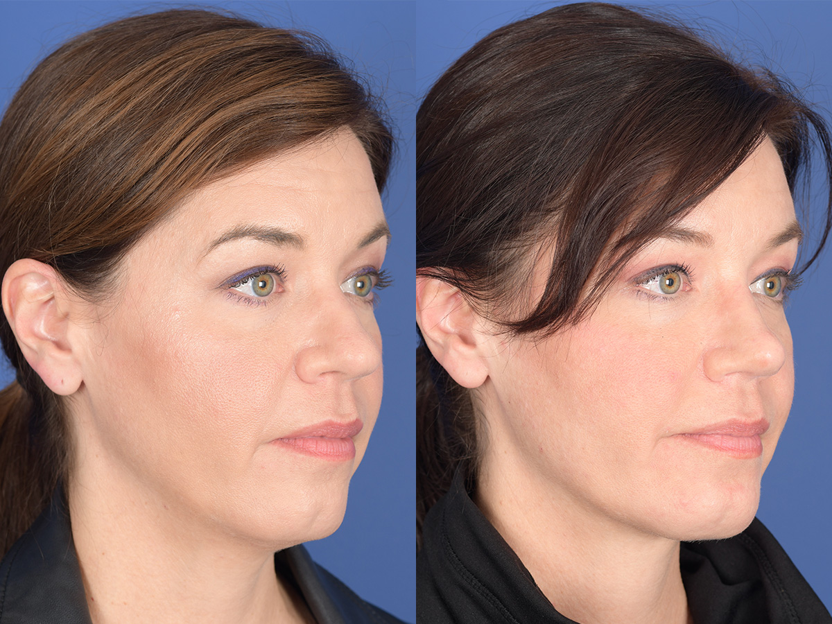 Rhinoplasty Before and After | Weber Facial Plastic Surgery