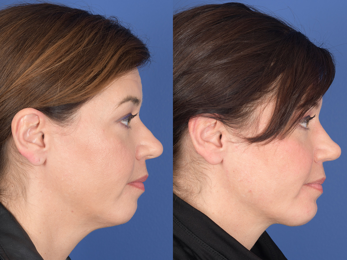 Rhinoplasty Before and After | Weber Facial Plastic Surgery