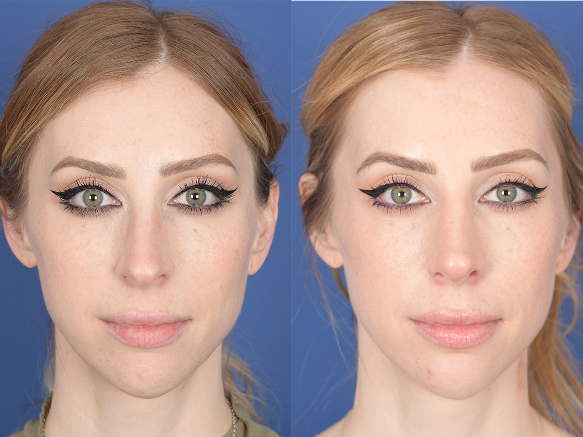 Rhinoplasty Before and After | Weber Facial Plastic Surgery