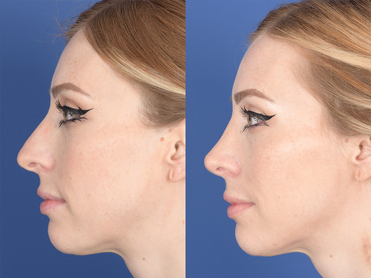 Rhinoplasty Before and After | Weber Facial Plastic Surgery
