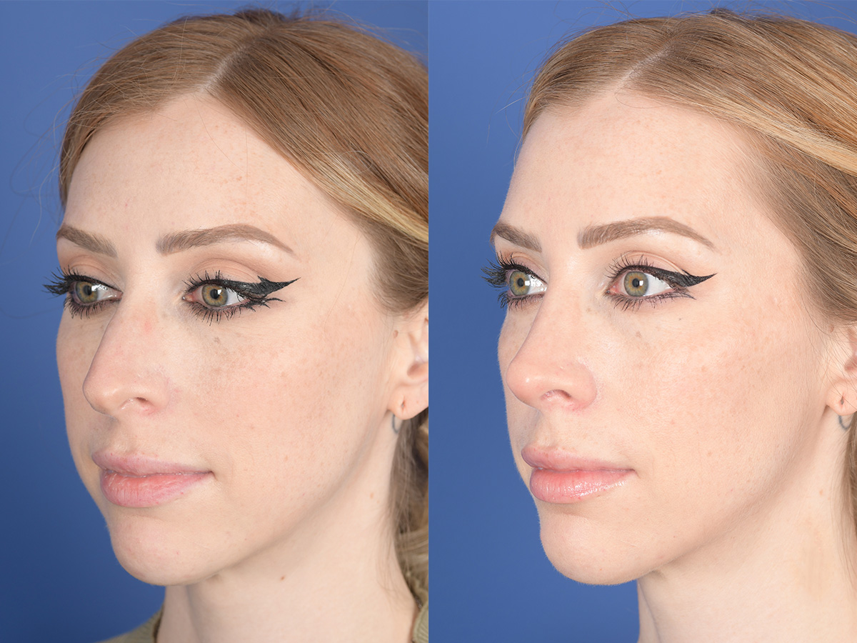 Rhinoplasty Before and After | Weber Facial Plastic Surgery