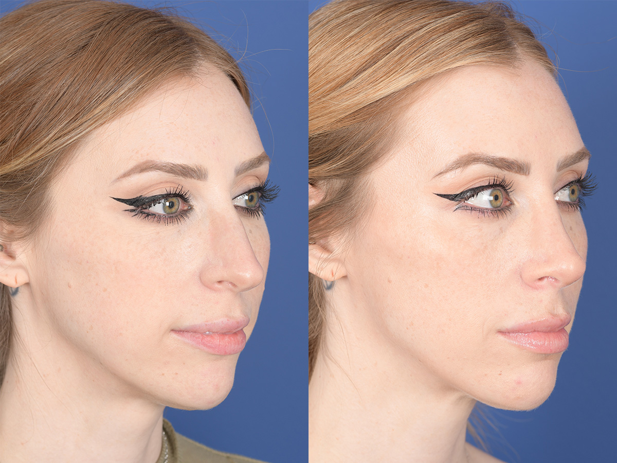 Rhinoplasty Before and After | Weber Facial Plastic Surgery