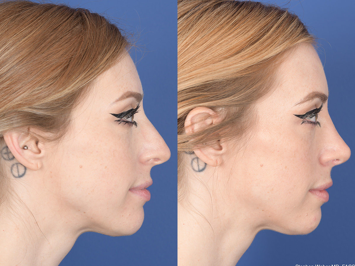 Rhinoplasty Before and After | Weber Facial Plastic Surgery