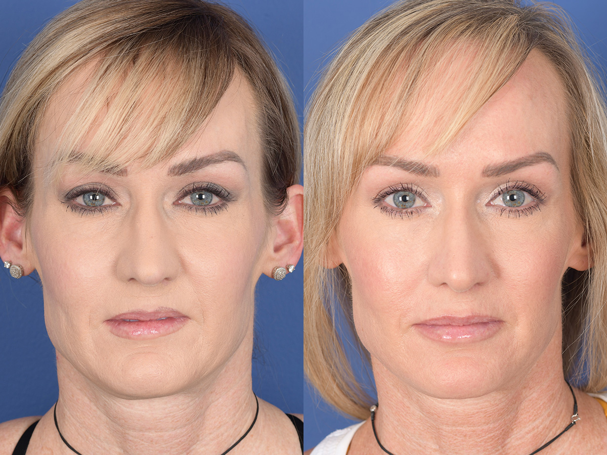 Rhinoplasty Before and After | Weber Facial Plastic Surgery