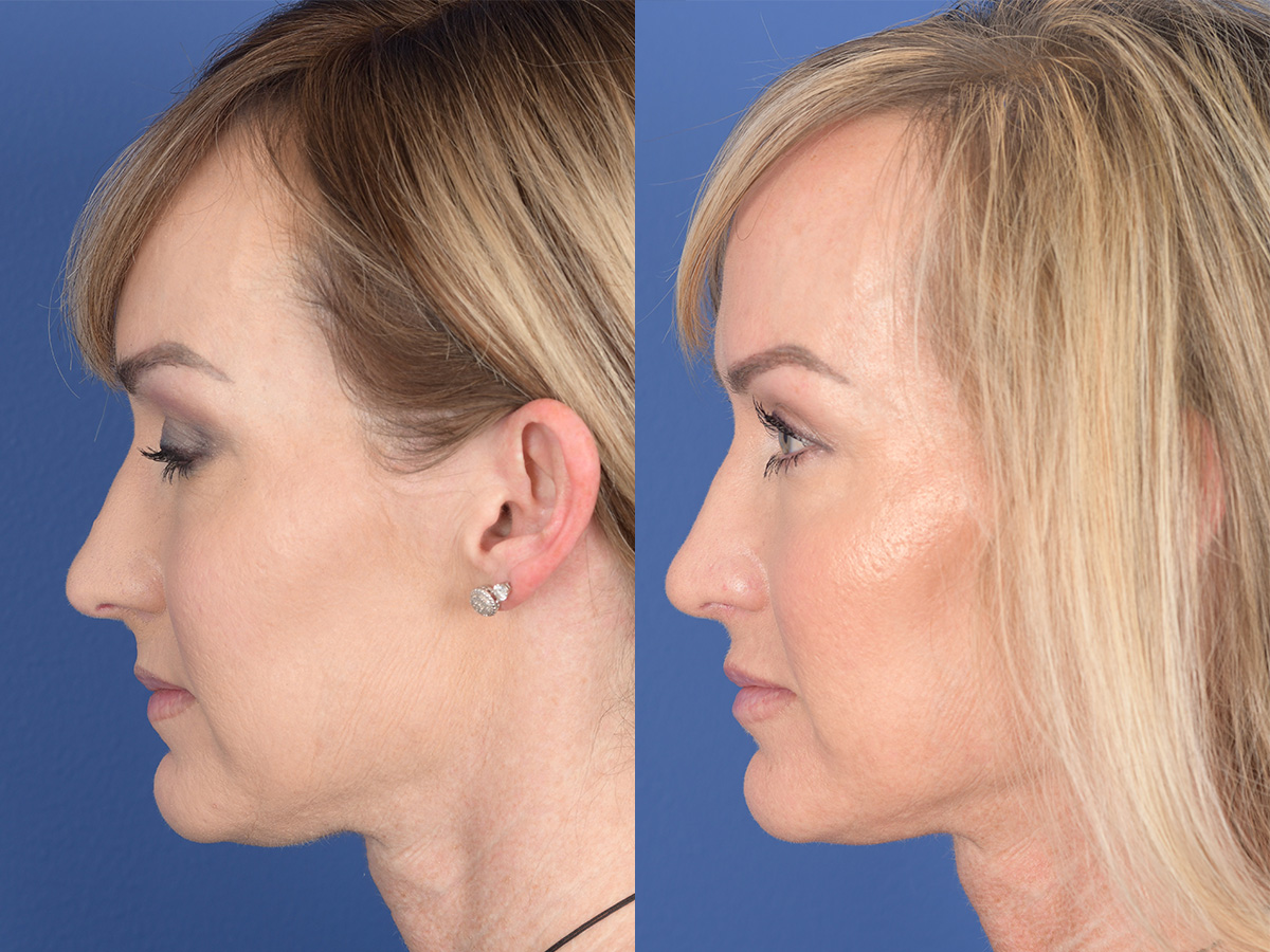 Rhinoplasty Before and After | Weber Facial Plastic Surgery