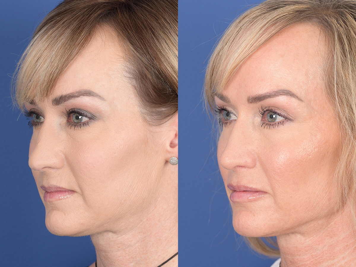 Rhinoplasty Before and After | Weber Facial Plastic Surgery