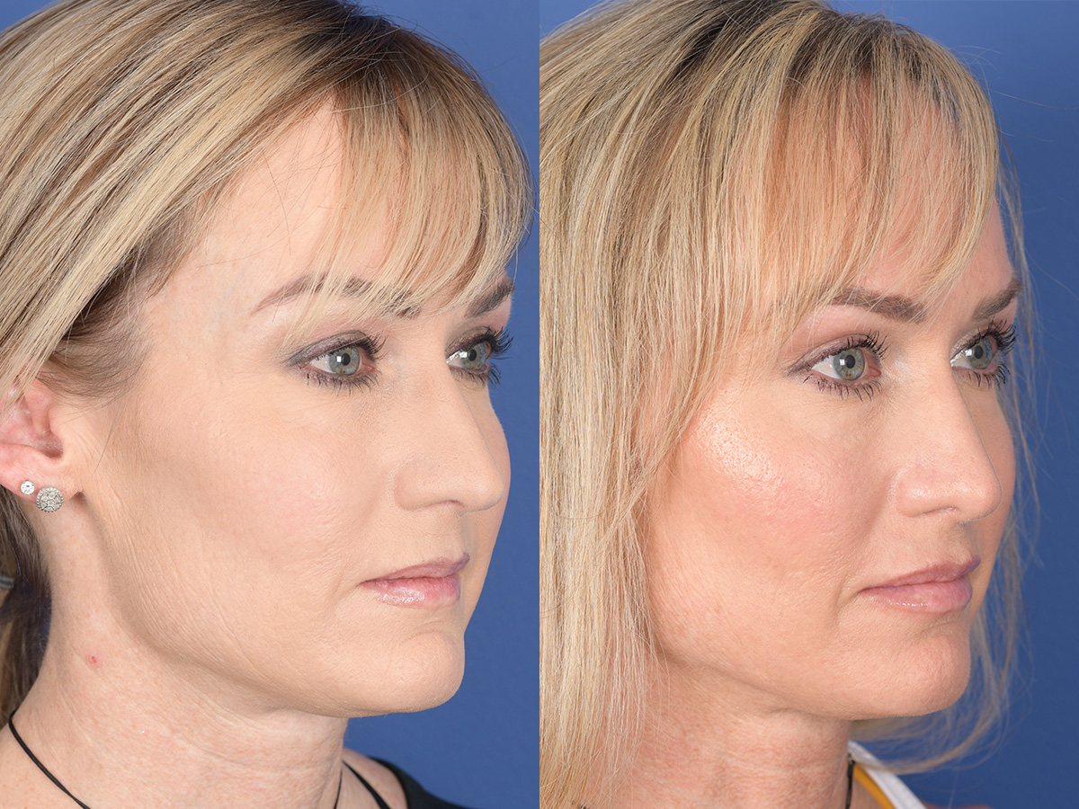 Rhinoplasty Before and After | Weber Facial Plastic Surgery