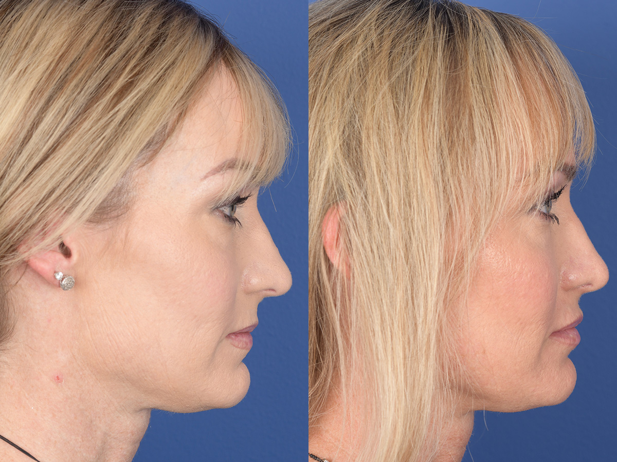 Rhinoplasty Before and After | Weber Facial Plastic Surgery