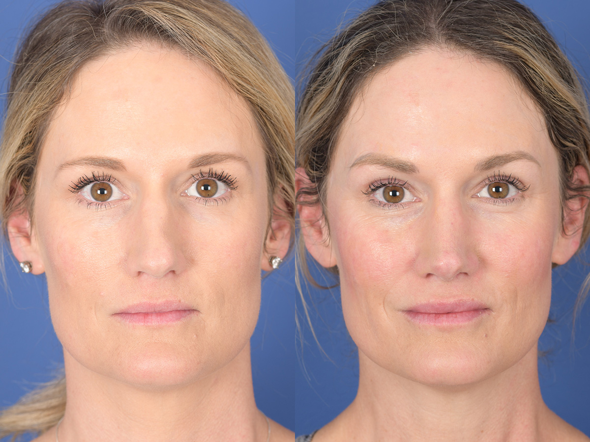 Rhinoplasty Before and After | Weber Facial Plastic Surgery