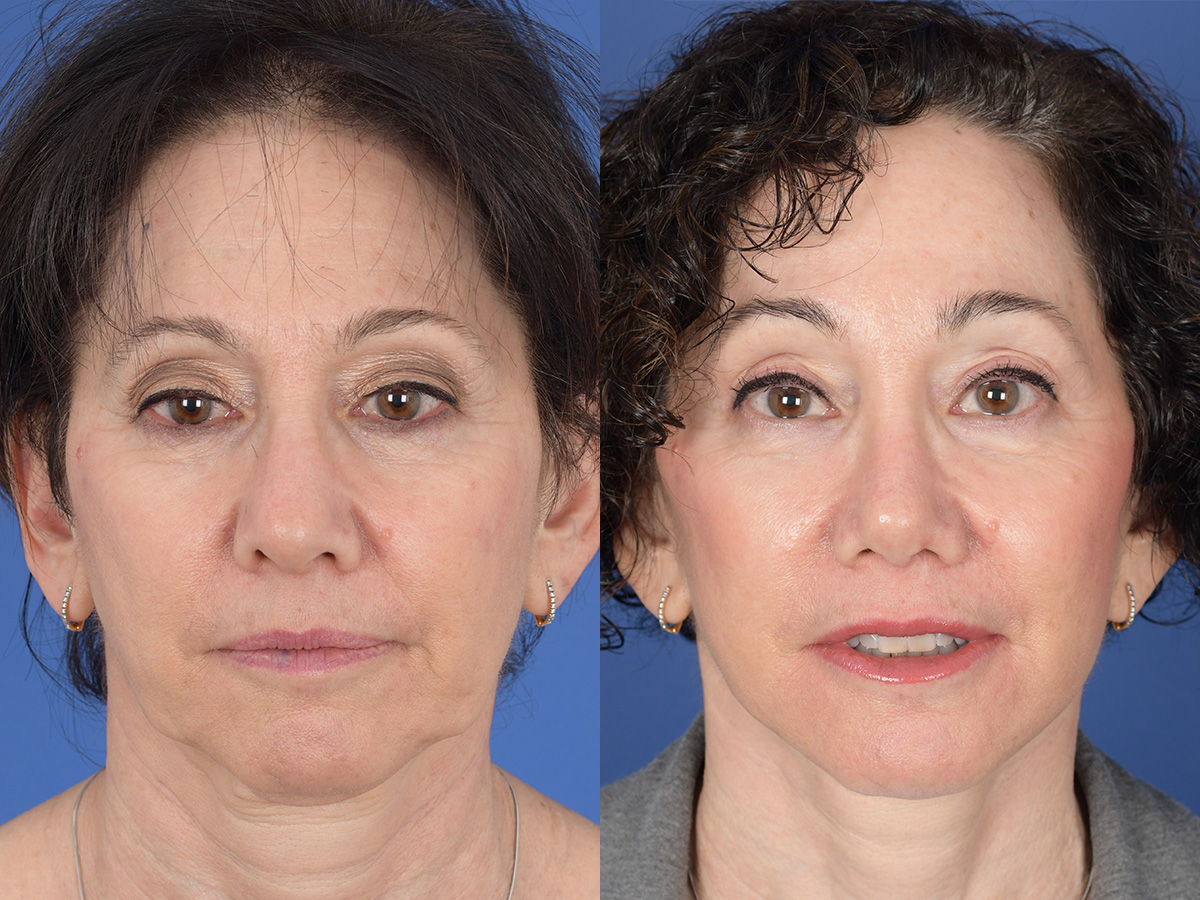 Rhinoplasty Before and After | Weber Facial Plastic Surgery