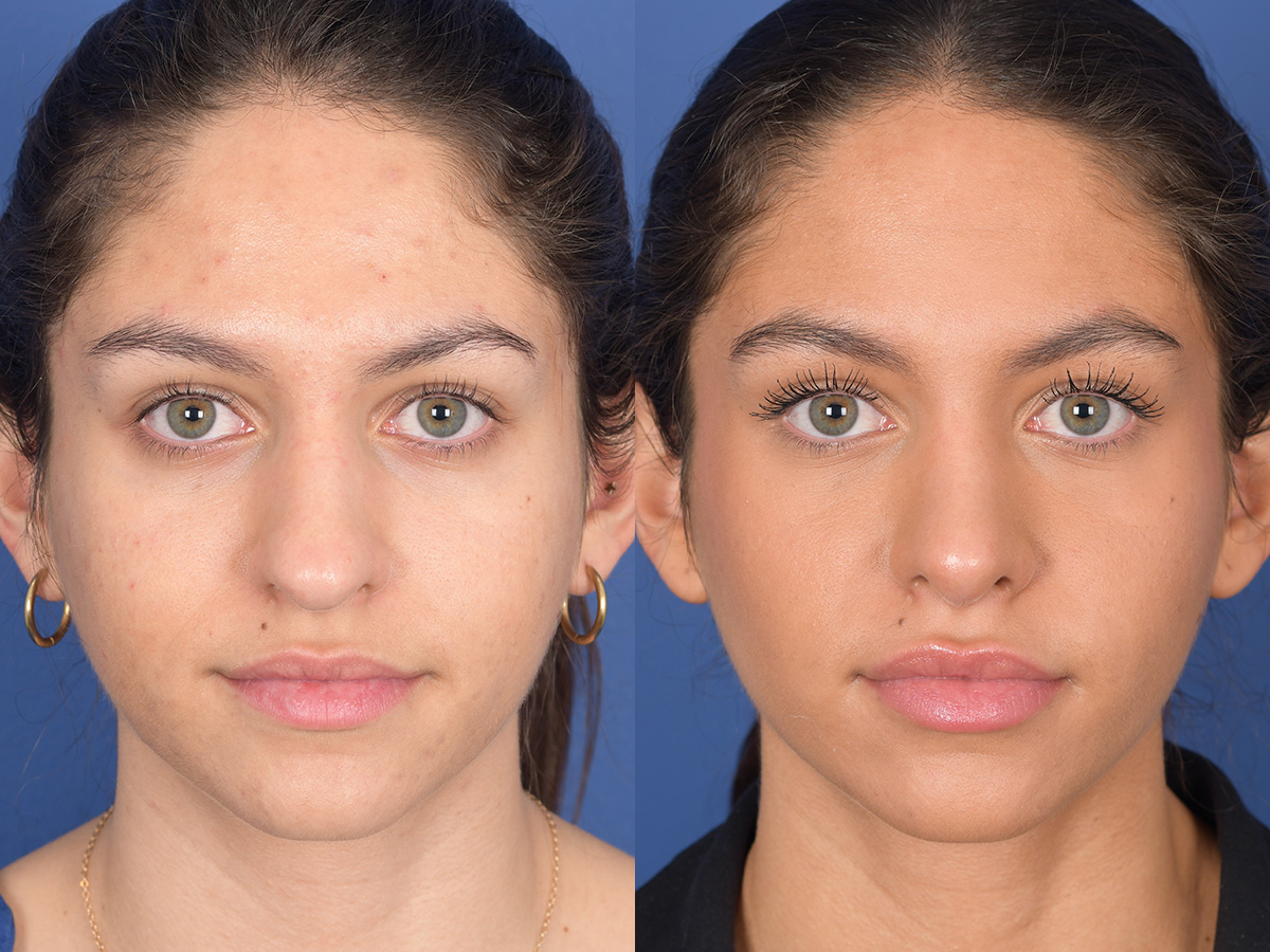 Rhinoplasty Before and After | Weber Facial Plastic Surgery