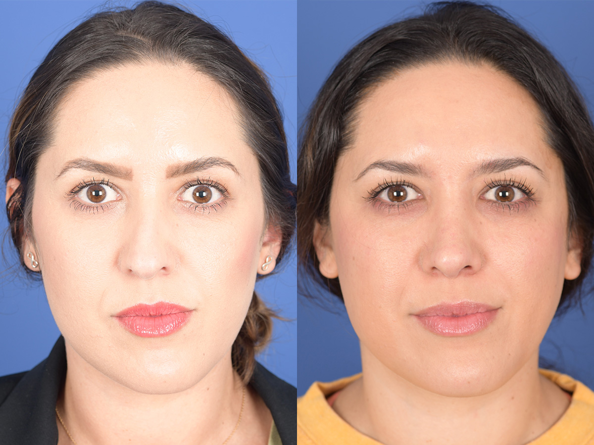 Rhinoplasty Before and After | Weber Facial Plastic Surgery