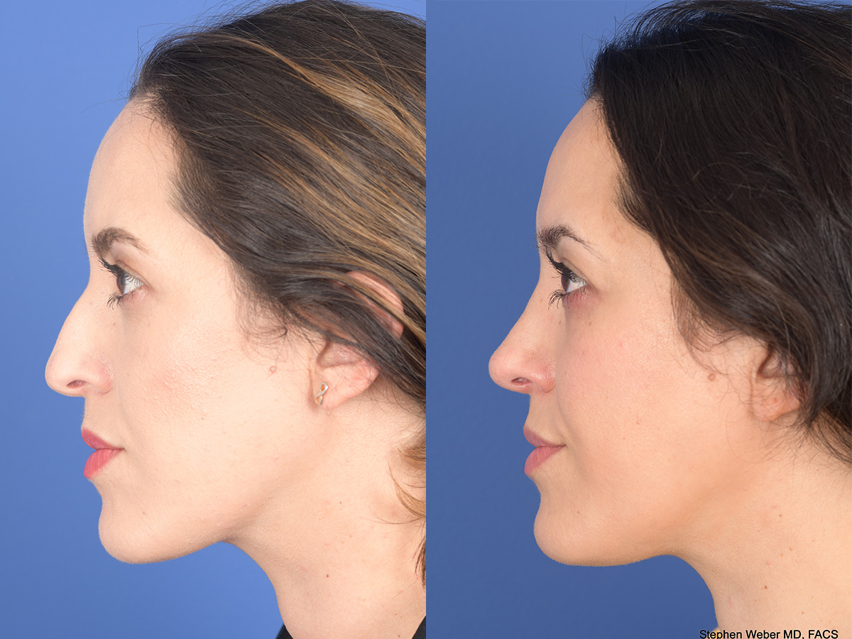 Rhinoplasty Before and After | Weber Facial Plastic Surgery