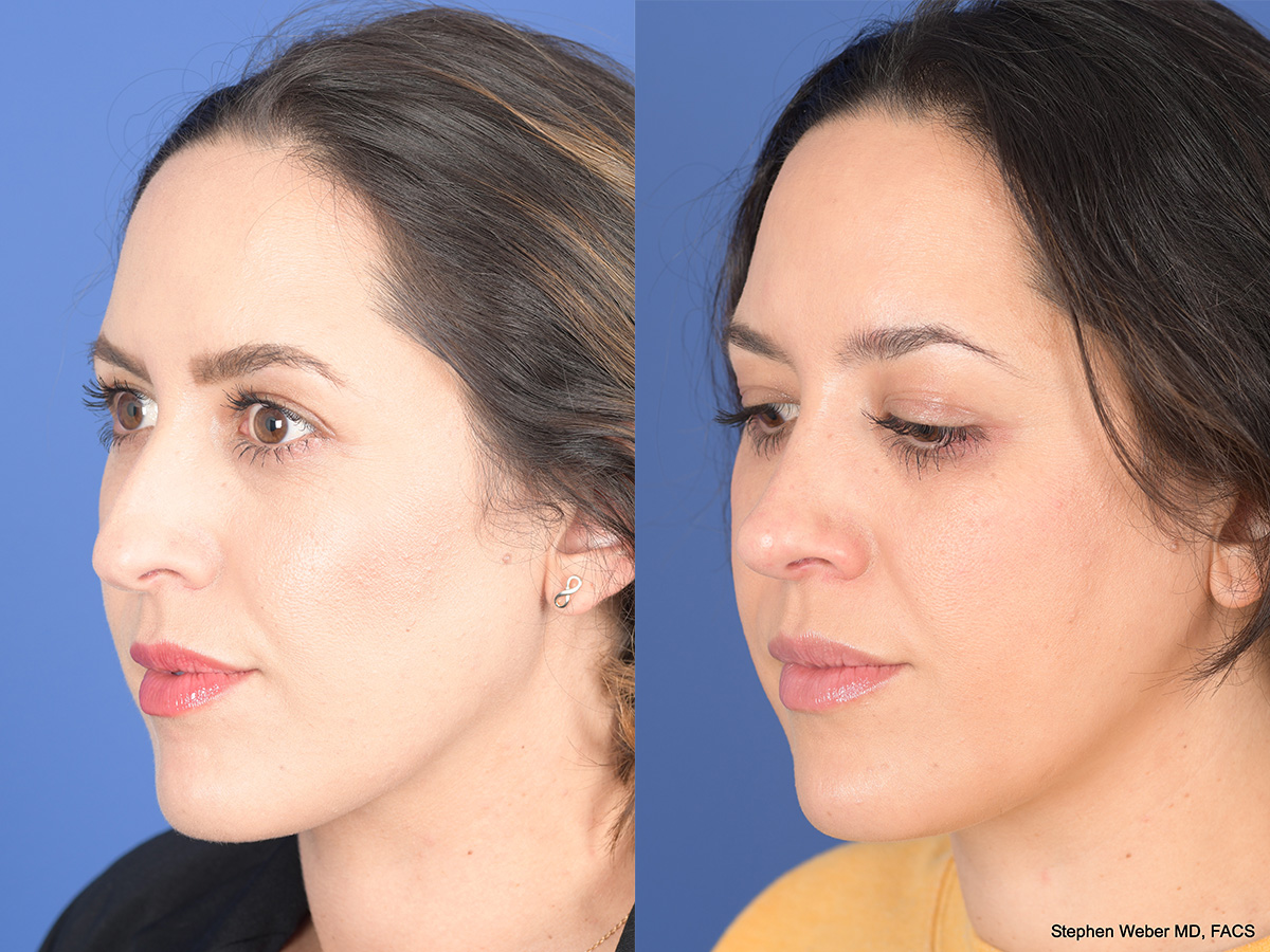 Rhinoplasty Before and After | Weber Facial Plastic Surgery