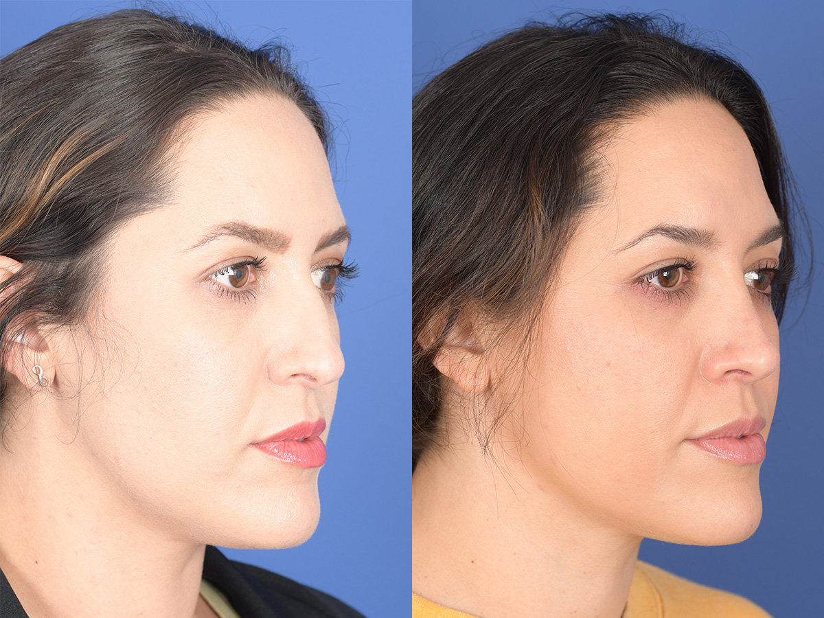Rhinoplasty Before and After | Weber Facial Plastic Surgery