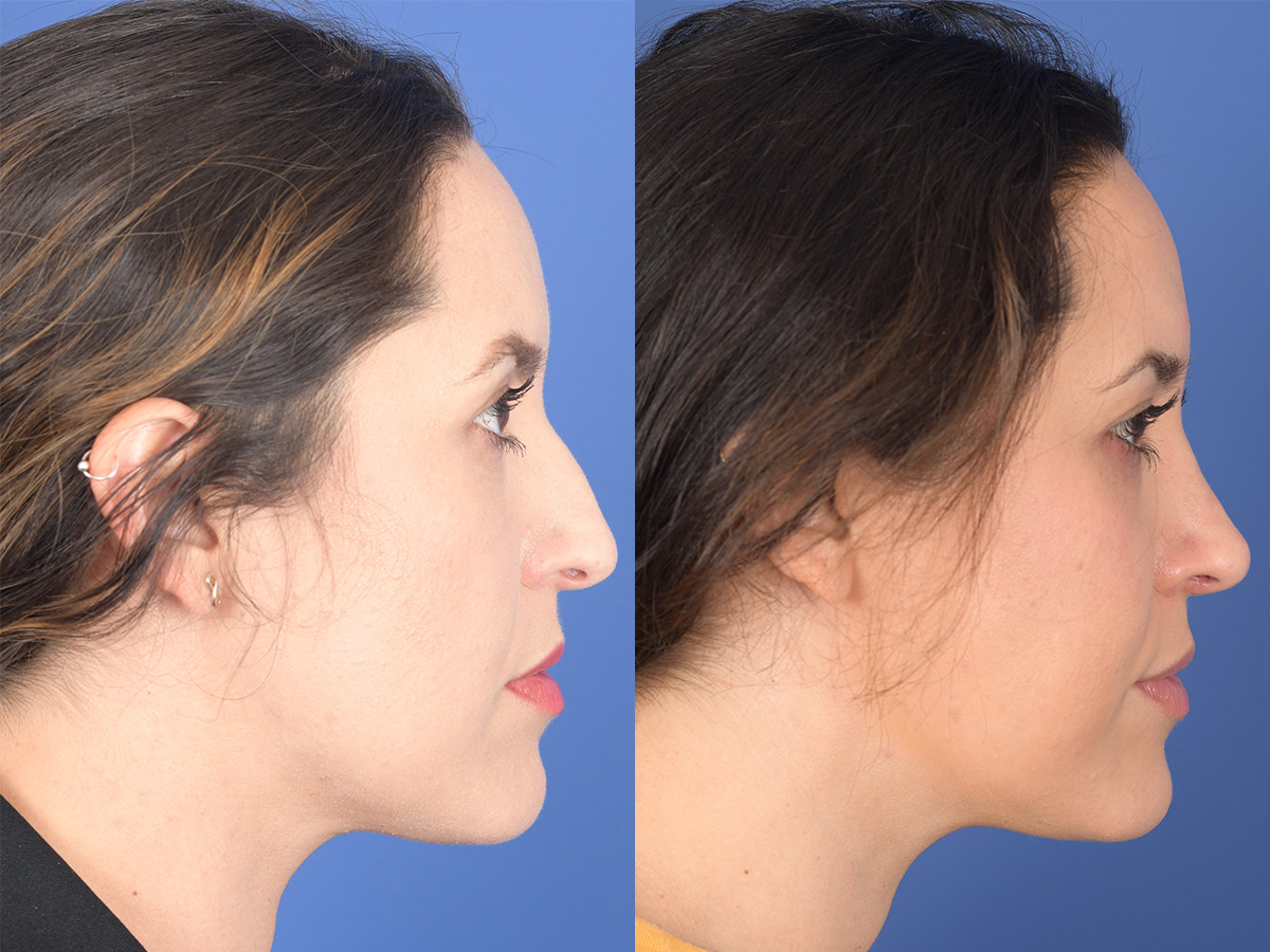 Rhinoplasty Before and After | Weber Facial Plastic Surgery