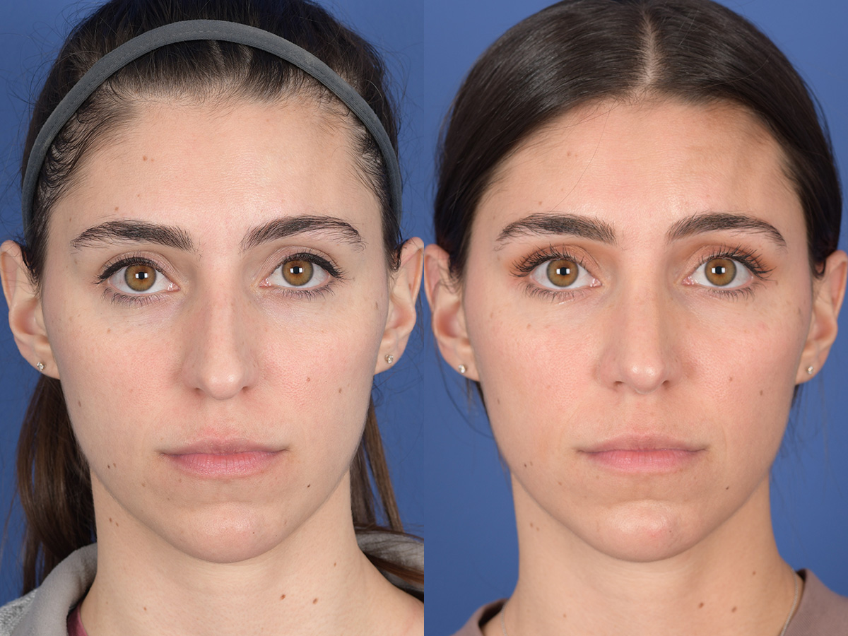 Rhinoplasty Before and After | Weber Facial Plastic Surgery