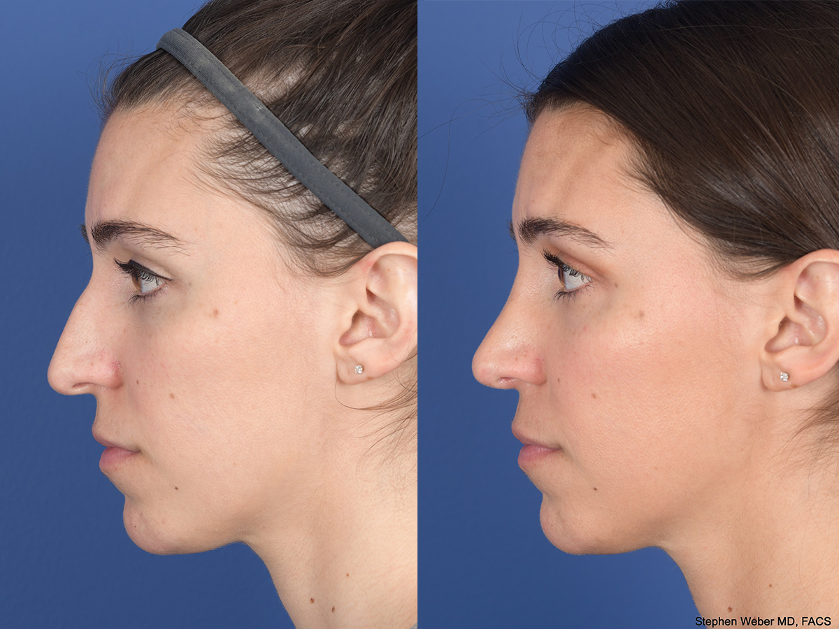 Rhinoplasty Before and After | Weber Facial Plastic Surgery